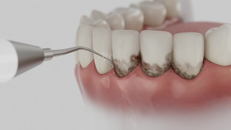 Trusted Wisdom Tooth Removal service in Bolivar, MO - Dentist Open Now